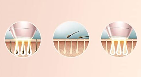 methode de fonctionement de la lumierer pulsee